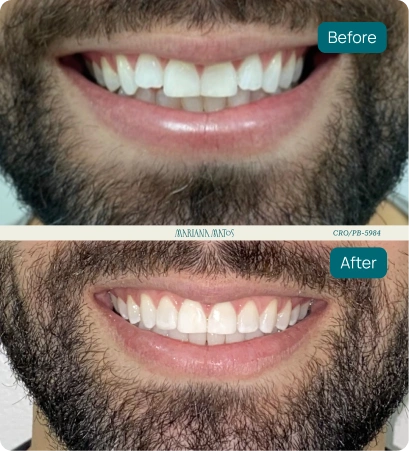 Comparação de antes e depois de tratamento odontológico.