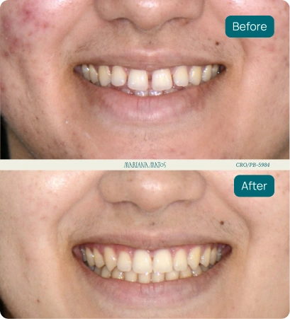 Comparação de antes e depois de tratamento odontológico.