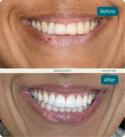 Comparação de antes e depois de tratamento odontológico.